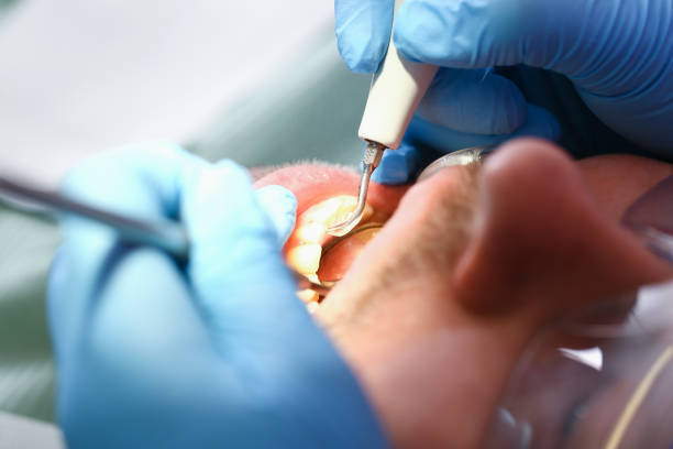 Best Emergency Wisdom Teeth Removal in Thornport, OH